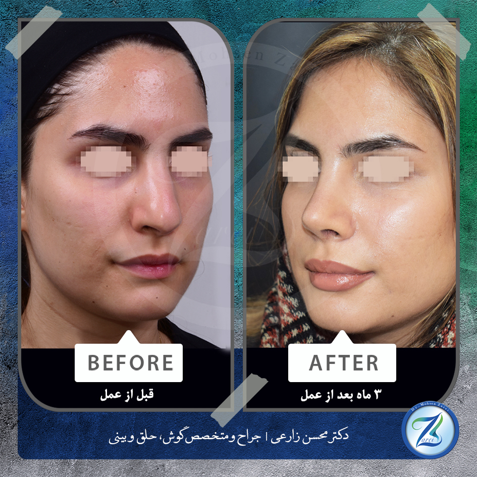 نمونه جراحی زیبایی بینی دکتر زارعی2