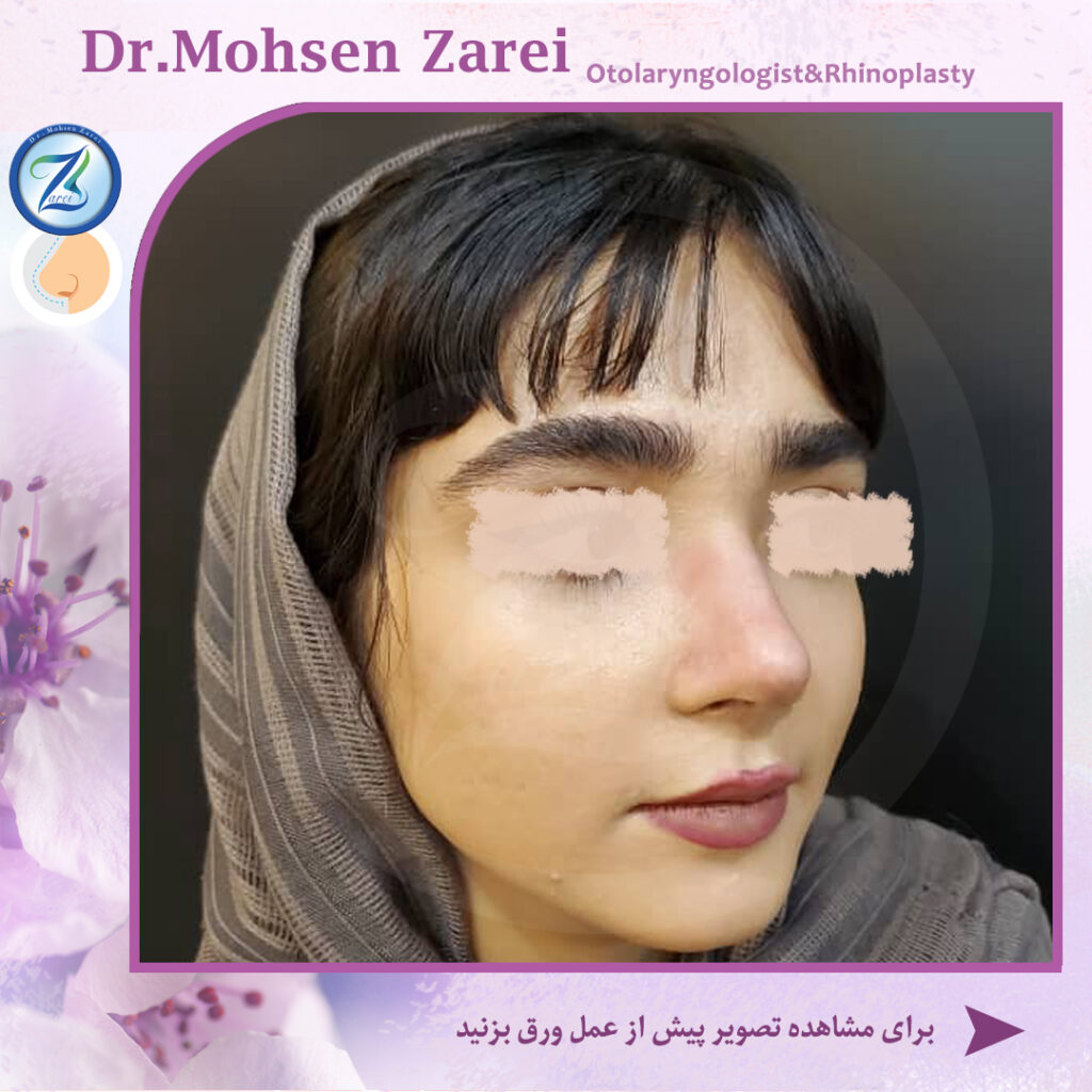 نمونه جراحی بعد از عمل بینی دکتر زارعی